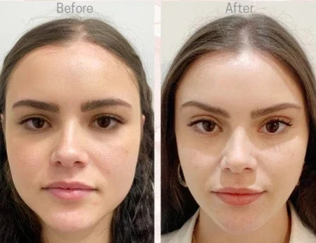 Face Lift - Adhésifs lifting invisible naturel