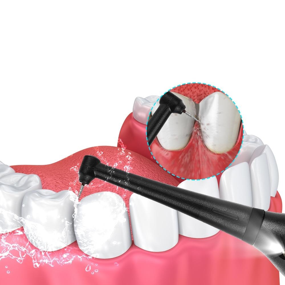 Détartreur dentaire électrique - Nouvelle génération